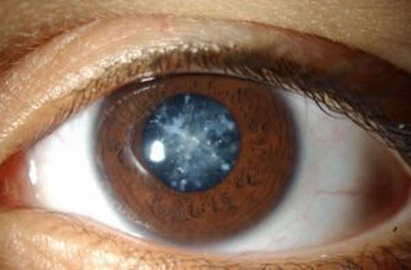 фото глаза с диабетической катарактой